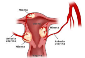 mioma uteri2